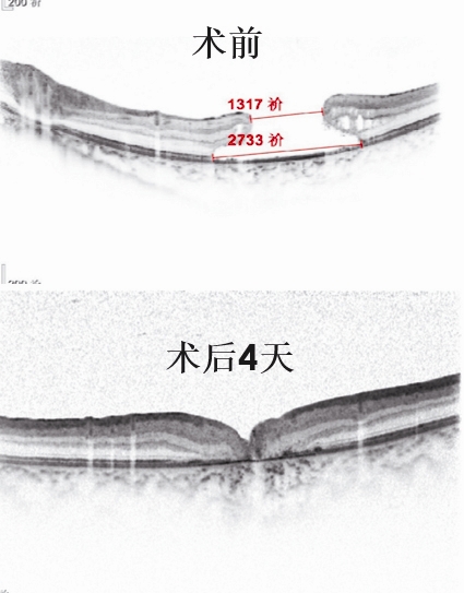 小学生眼睛出现罕见的巨大黄斑裂孔 竟是因为激光笔